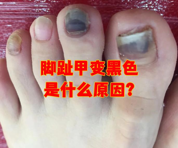 脚指甲为什么变黑变厚用什么药为什么在线 脚指甲为什么变黑变厚用什么药为什么在线