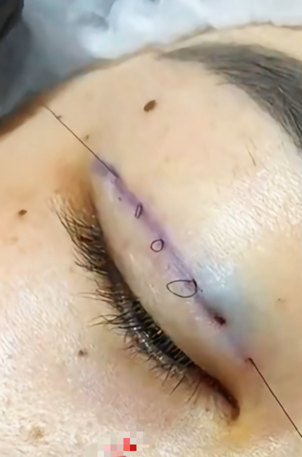 如果觉得内双不好看,可以通过双眼皮手术来改善,常见的有埋线双眼皮