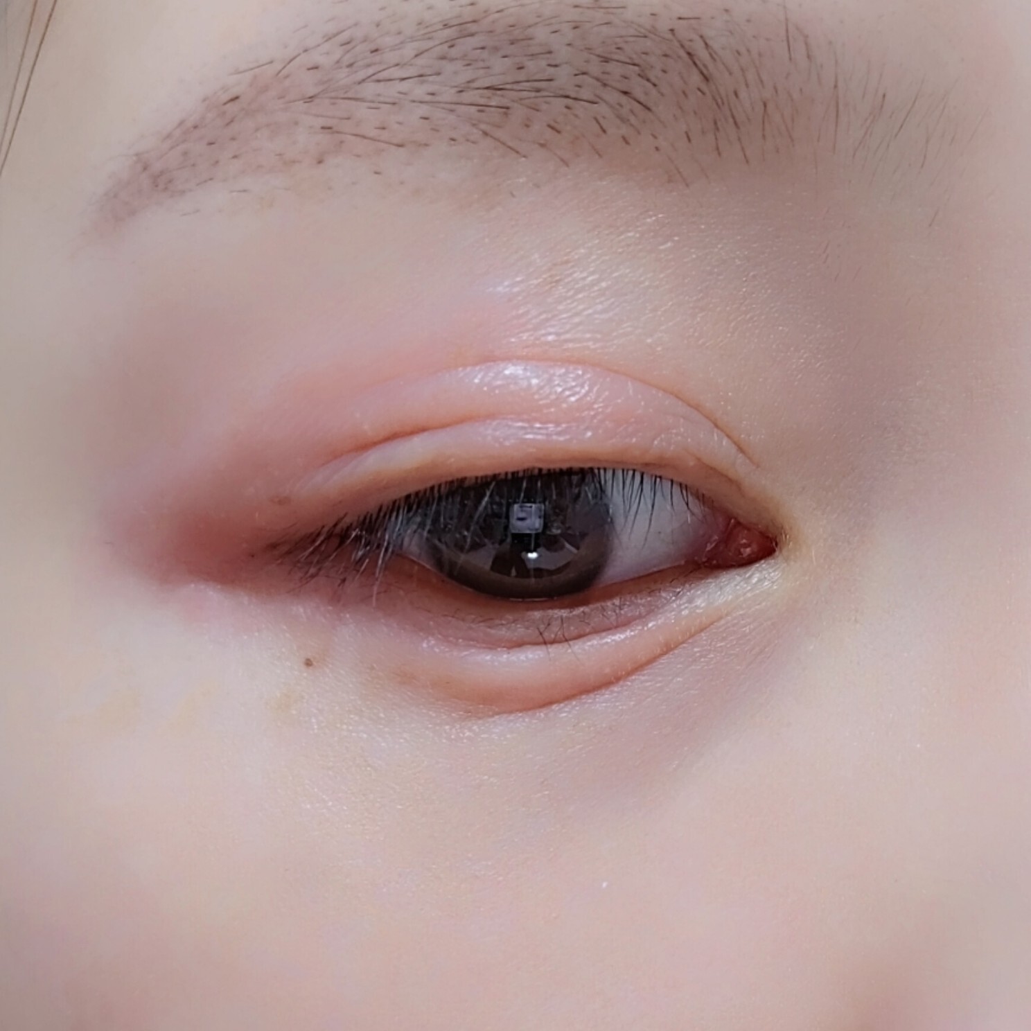 眼皮过敏,又红又肿还痒