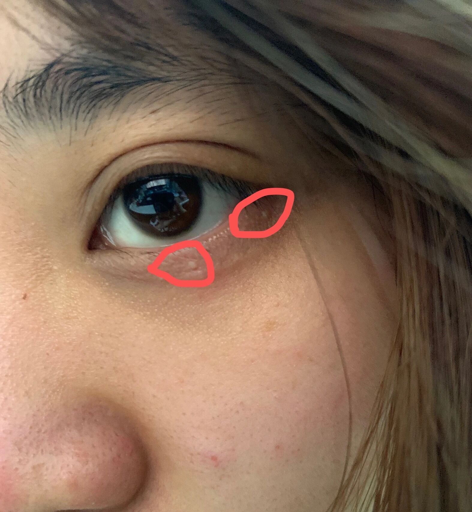 眼部长了白色的颗粒 先问一下大家,这是什么东西啊,在我眼睛周围很久