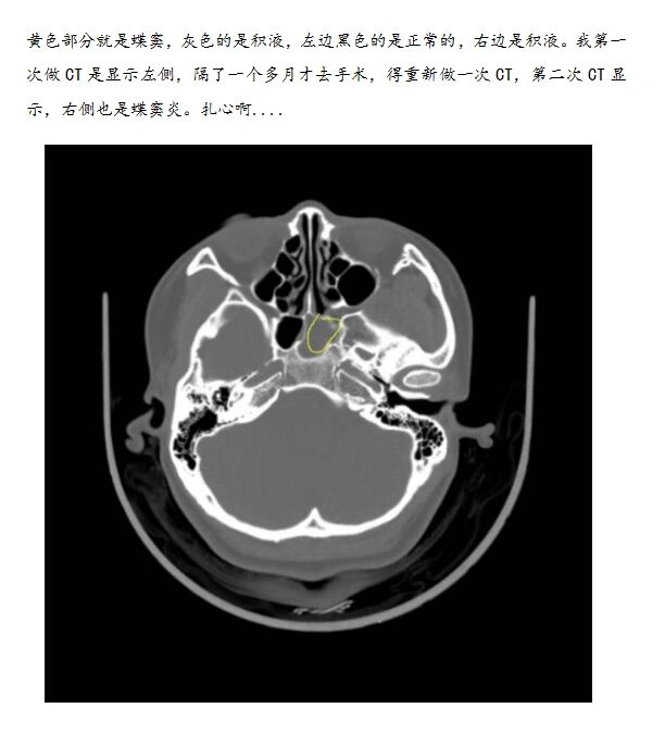 蝶窦炎发病会影响头晕,把它详细解答了一下 后台收了很多姐妹的私信