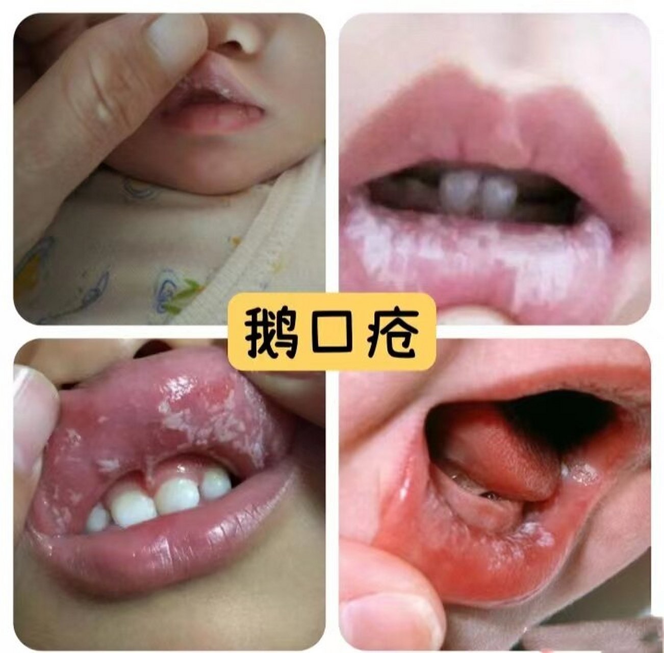 宝宝有鹅口疮,不能乱用药 如果宝宝有鹅口疮会蔓延到喉咙,宝宝的声音