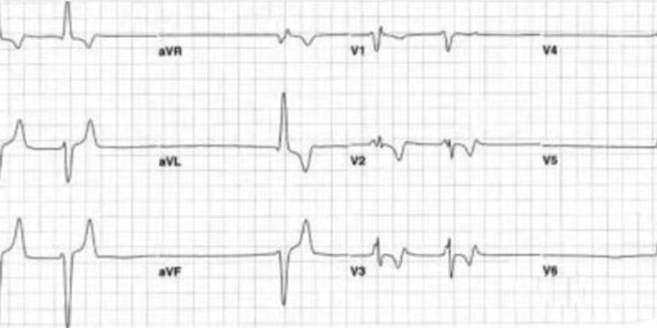 逸搏心律心电图特点图片