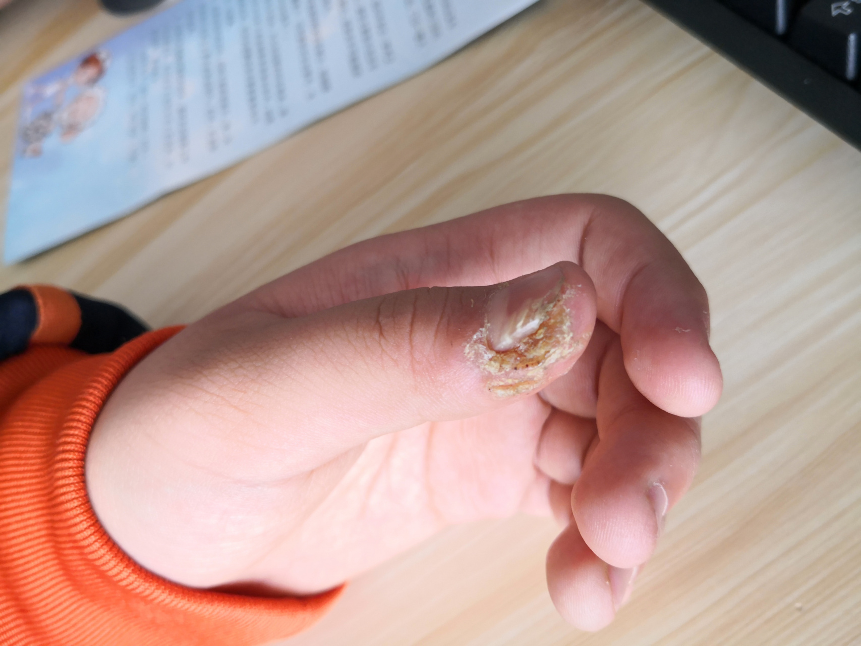 甲周疣.可以使用药物涂擦配合理疗治疗.