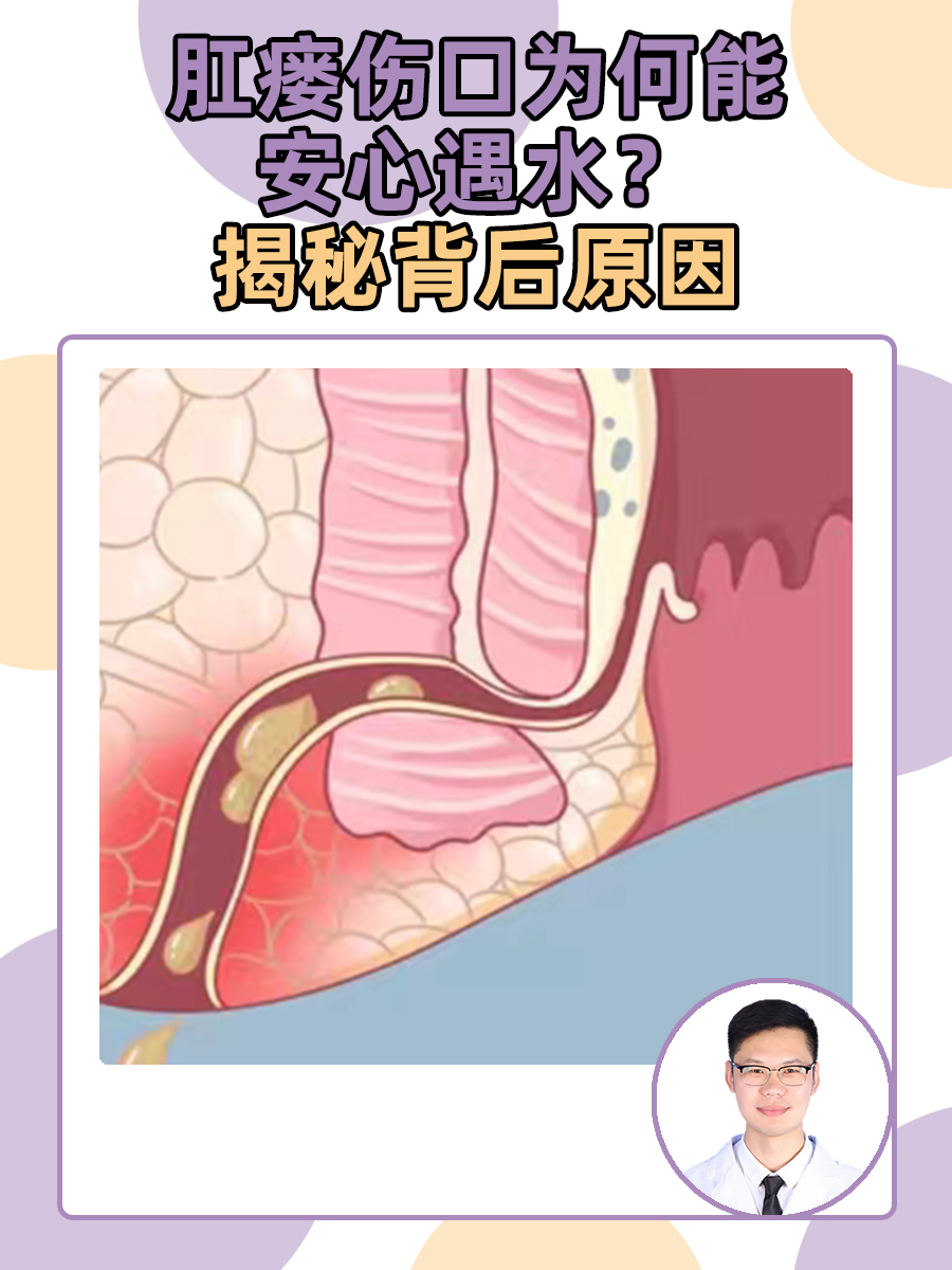 肛漏 原因图片