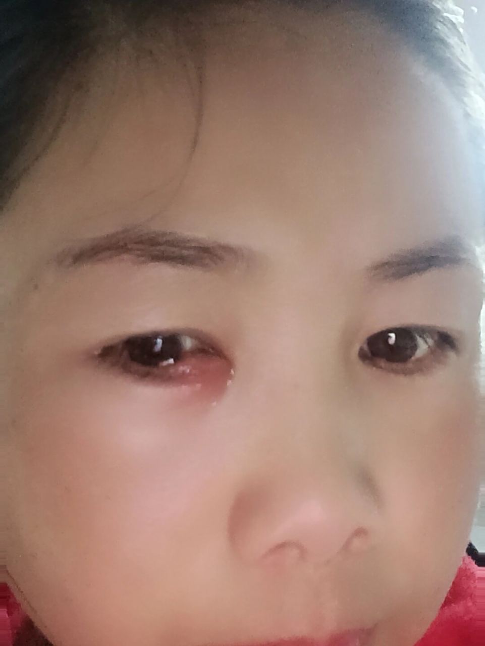 眼角长了一个疙瘩