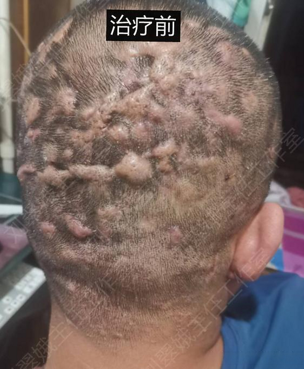 头上脓包疙瘩不断,中医这次帮他"一举拿下"!