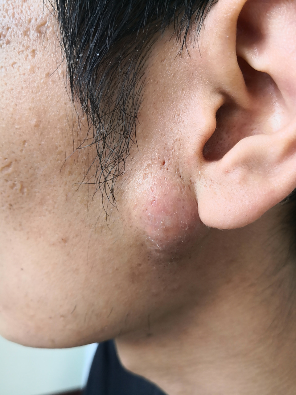 耳垂下方的囊肿性痤疮症状.可以使用激光治疗去除内容物.