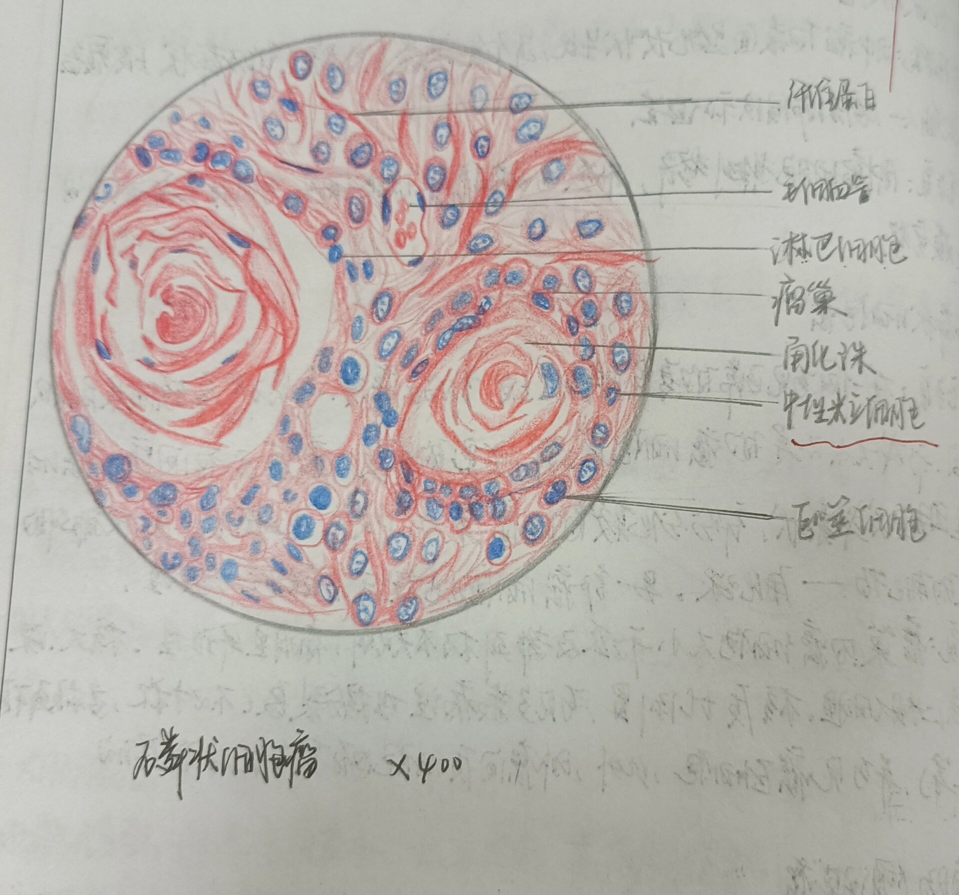 鳞状细胞癌绘图图片