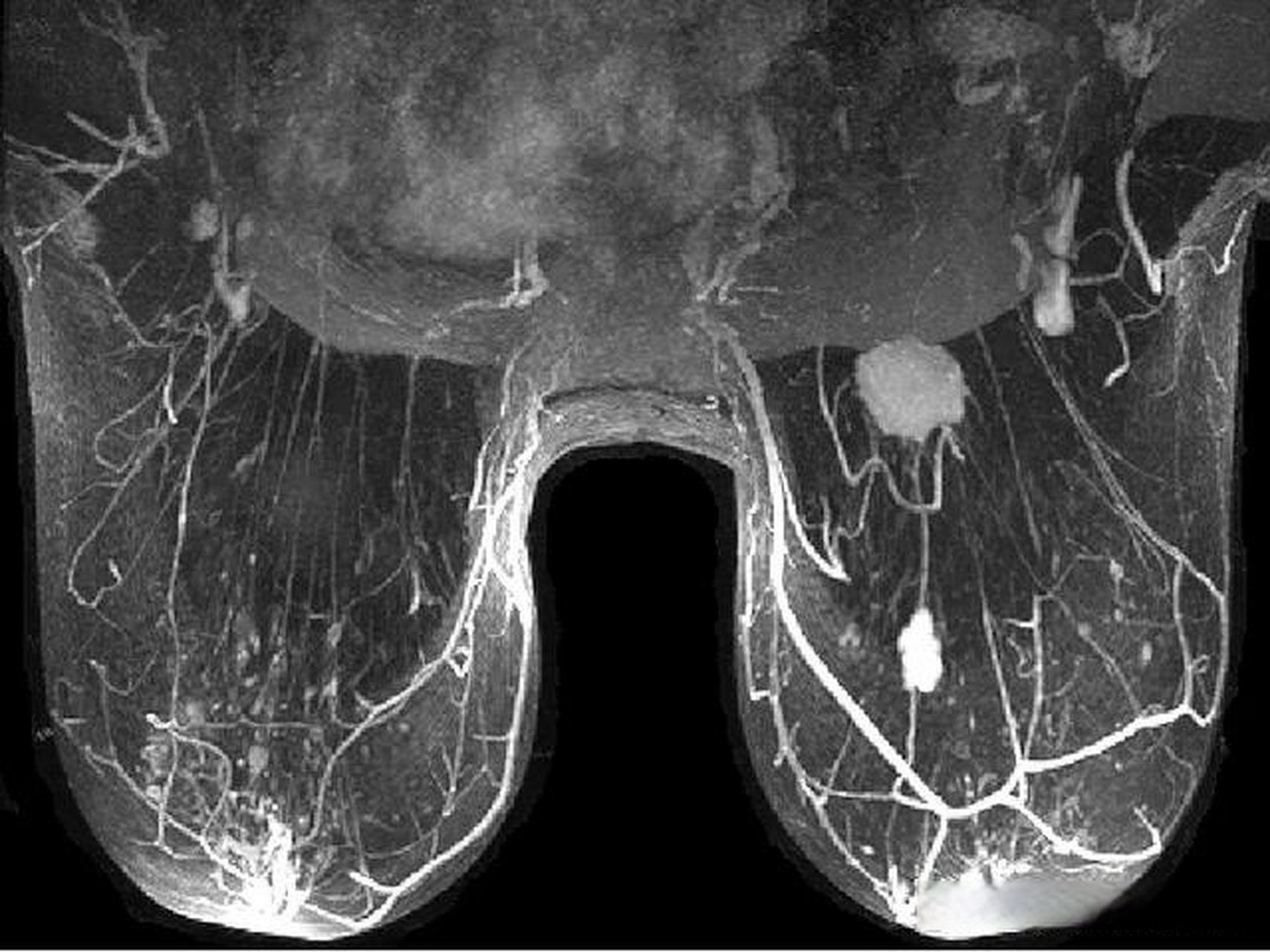 磁共振乳腺成像