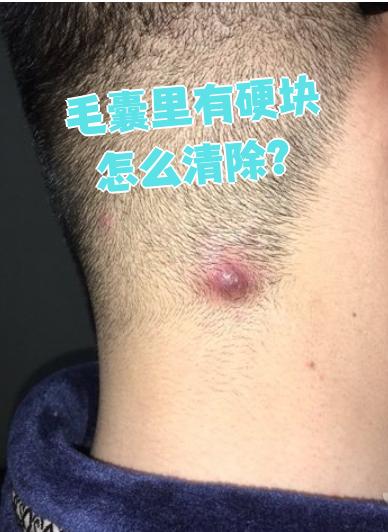 毛囊里出现硬块通常是细菌性毛囊炎引起的