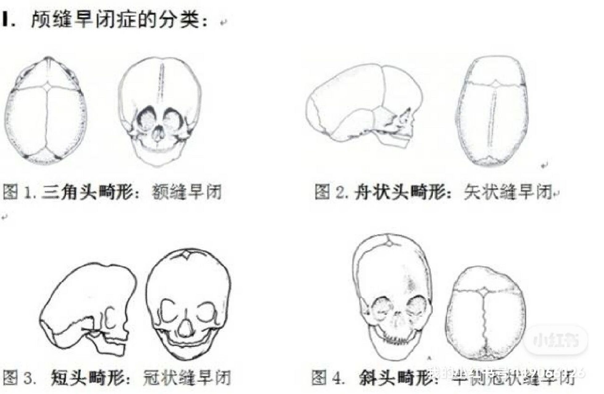 矢状缝冠状缝图片