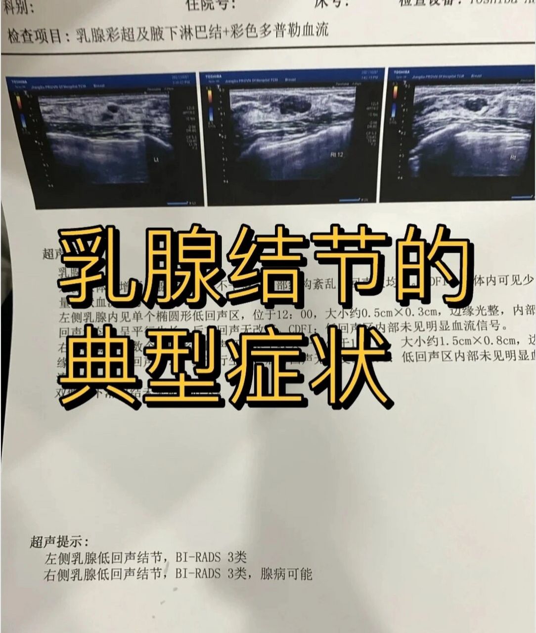 乳腺结节的典型症状 1-乳房肿块:常为多发性,大小不一,可以推动按压有