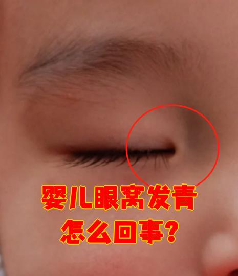 婴儿眼窝发青可能和生理或病理因素有关