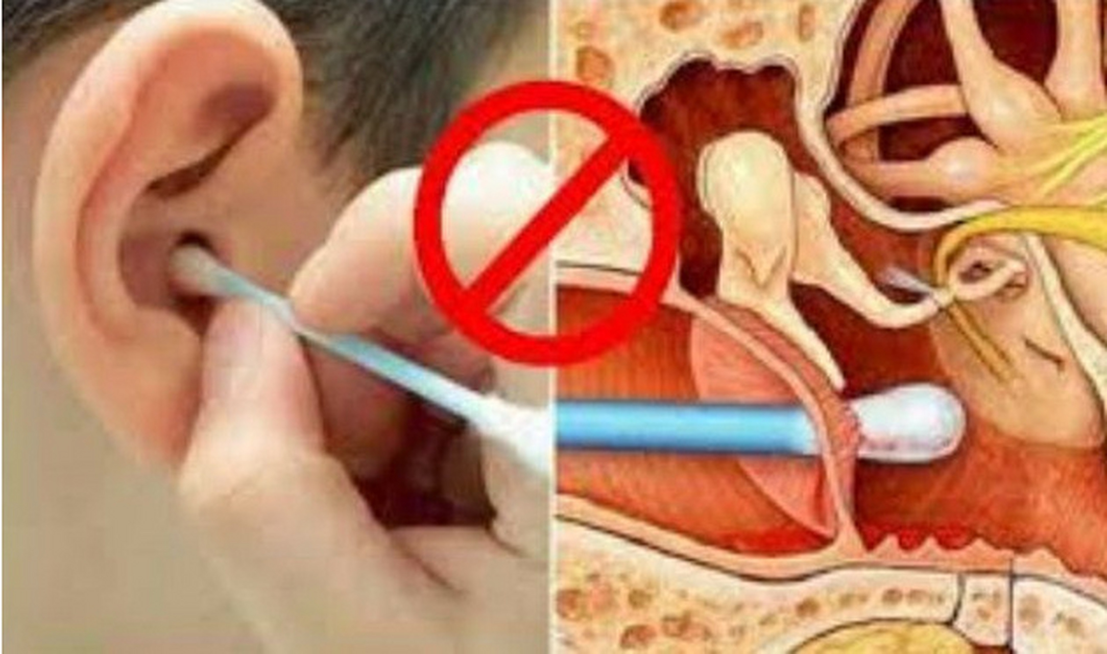 耵聍栓塞了,怎么办?