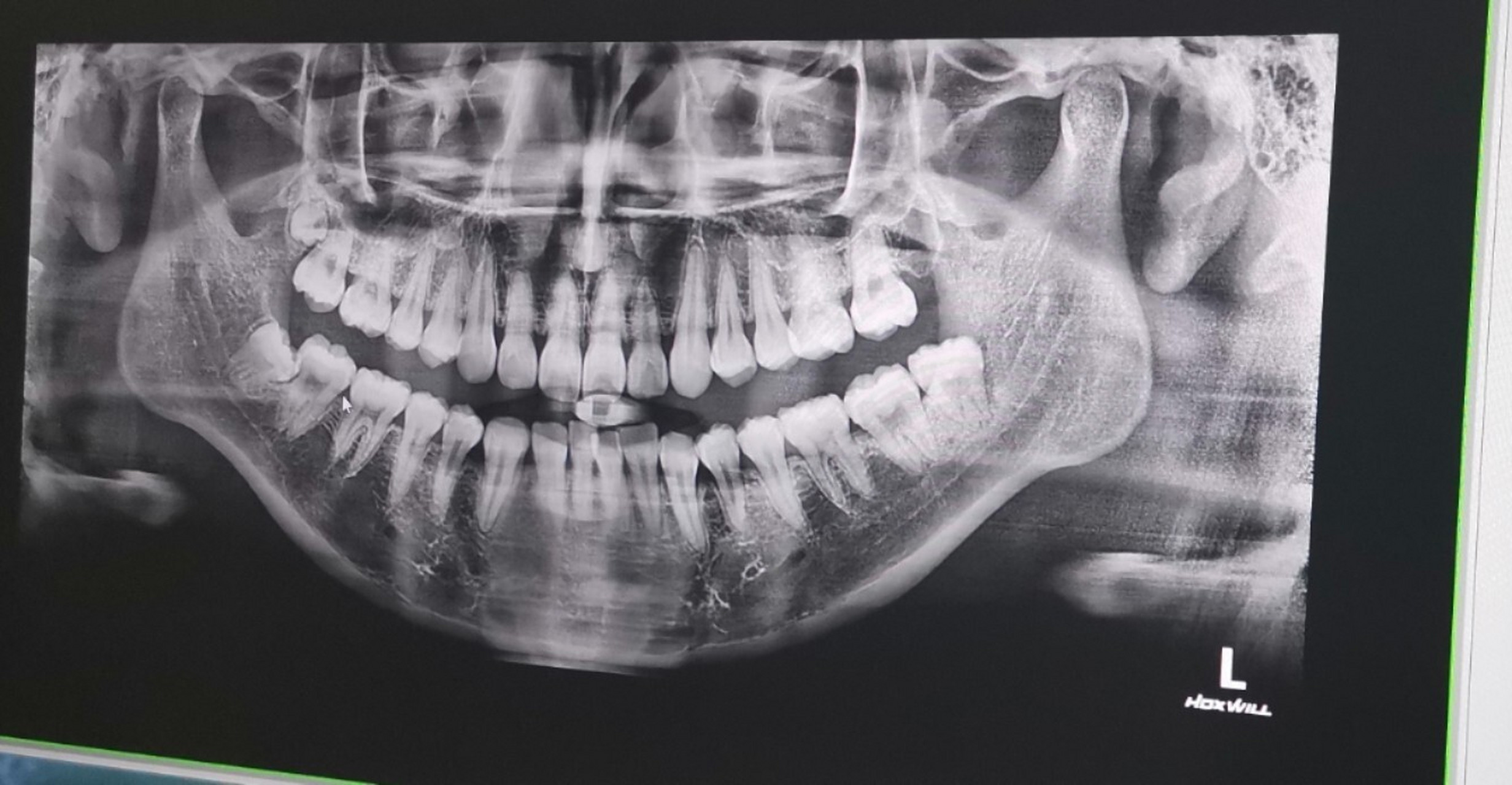 智齿发炎,要不要拔 之前在牙科诊所拍的片子,那里的医生建议我拔掉