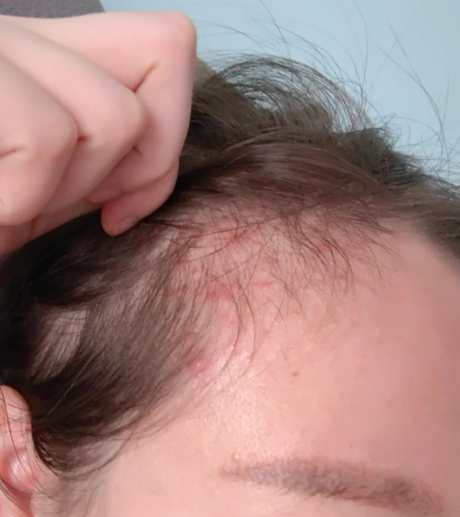 为什么老长痘 为什么老长痘