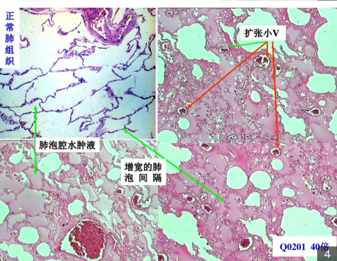 急性肺淤血40×手绘图图片