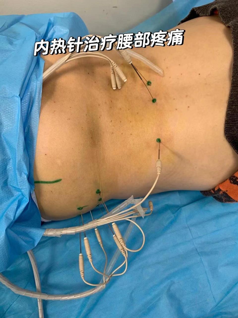 内热针治疗腰部疼痛真的很有效