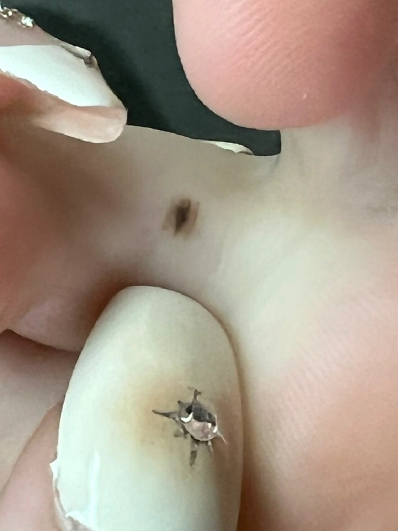 左脚趾缝间的痣,边缘不规则,且颜色不均匀,我超害怕,有人能帮我看看