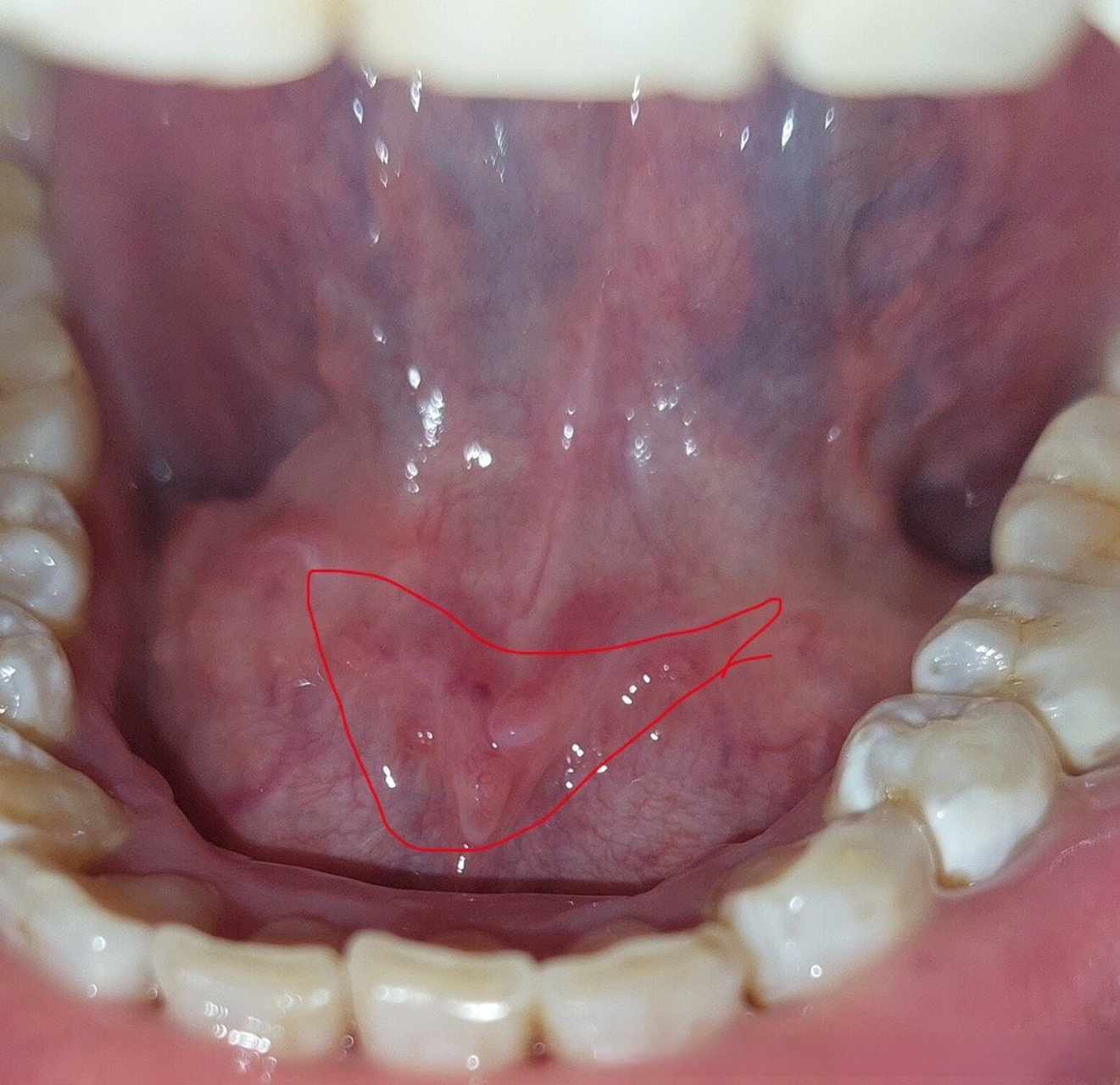 健康美好生活计划# 高医生您好,我发现自己舌头下面长了东西[大哭]