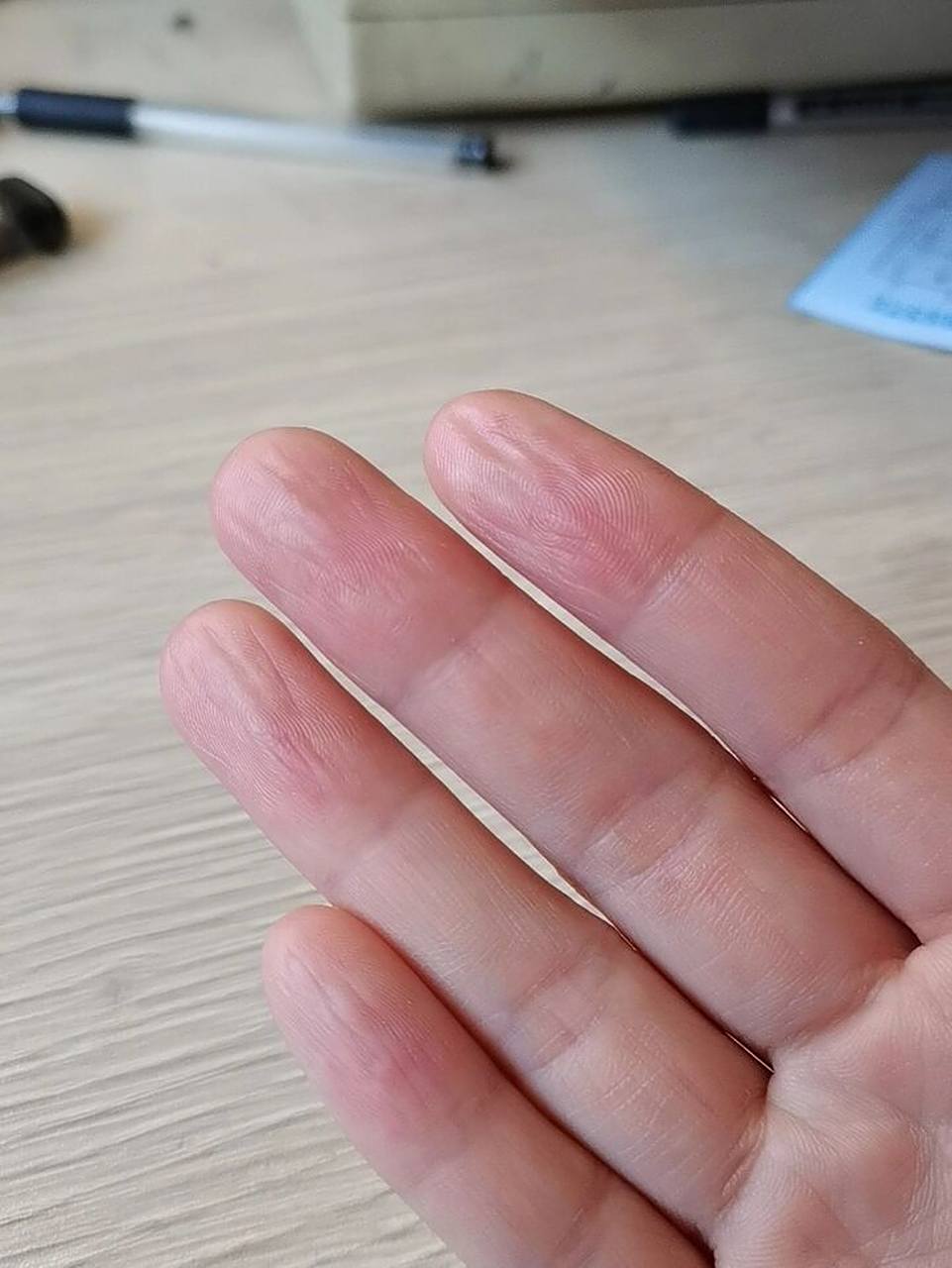 手指肚干瘪是怎么回事