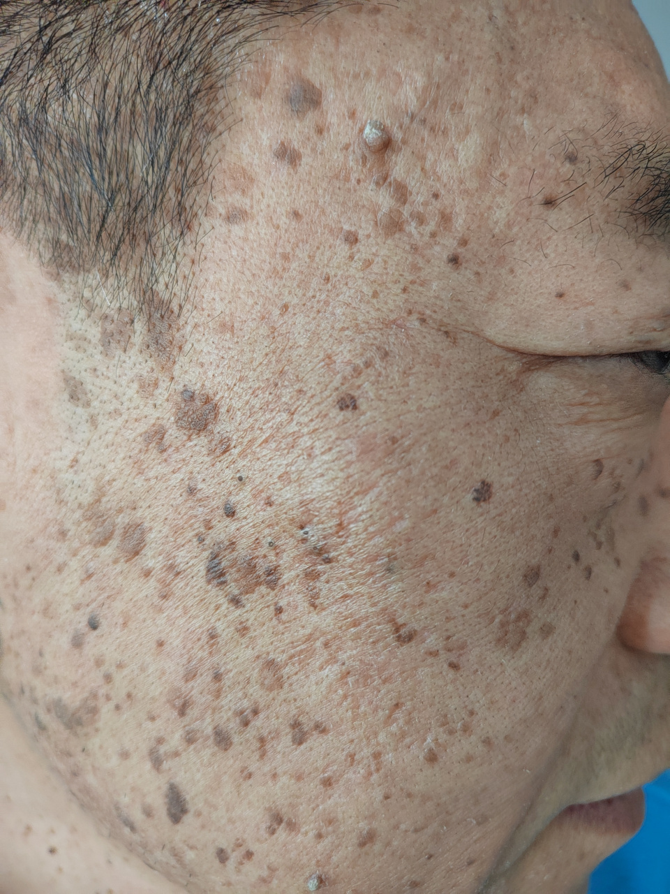 面部颈周老年斑脂溢性角化和皮赘症状.激光治疗去除简单方便效果可靠!