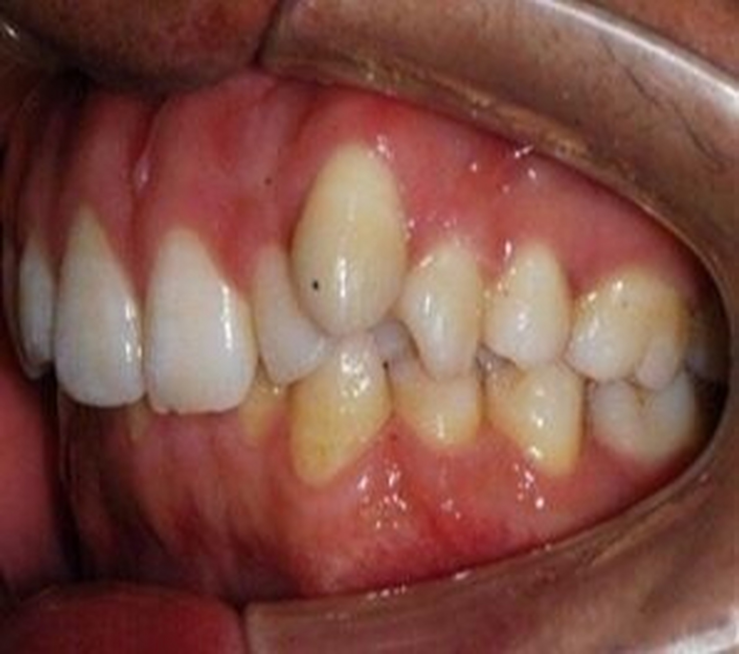 "龅牙"是深覆颌还是深覆盖,两者如何区分 很多家长在咨询儿童牙齿矫治