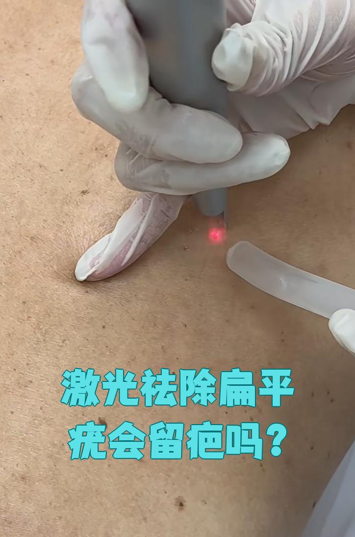 激光祛除扁平疣会不会留疤要看具体情况