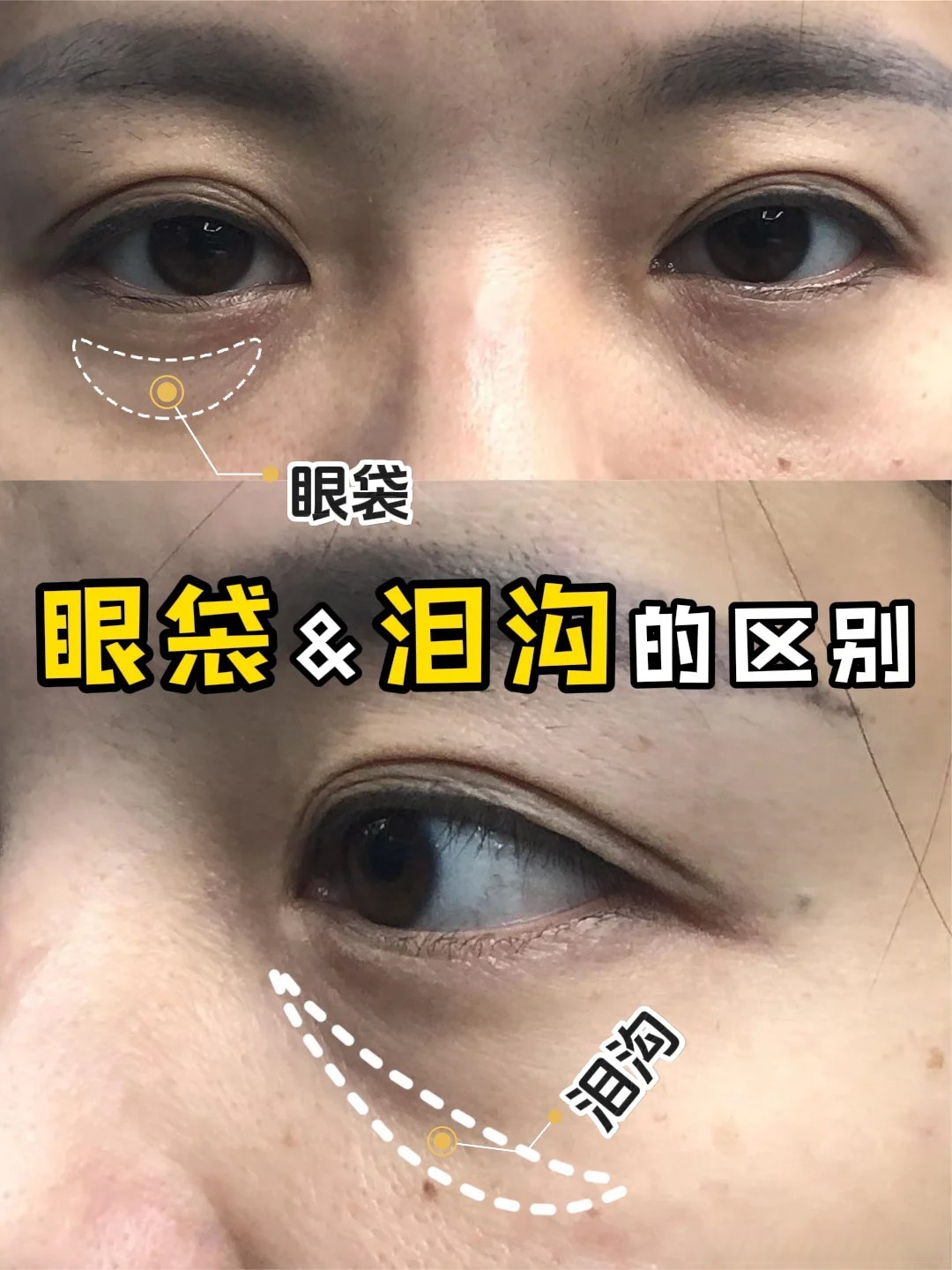 一篇搞懂,眼袋&泪沟的区别 眼袋和泪沟,因为常常伴随着出现在眼下