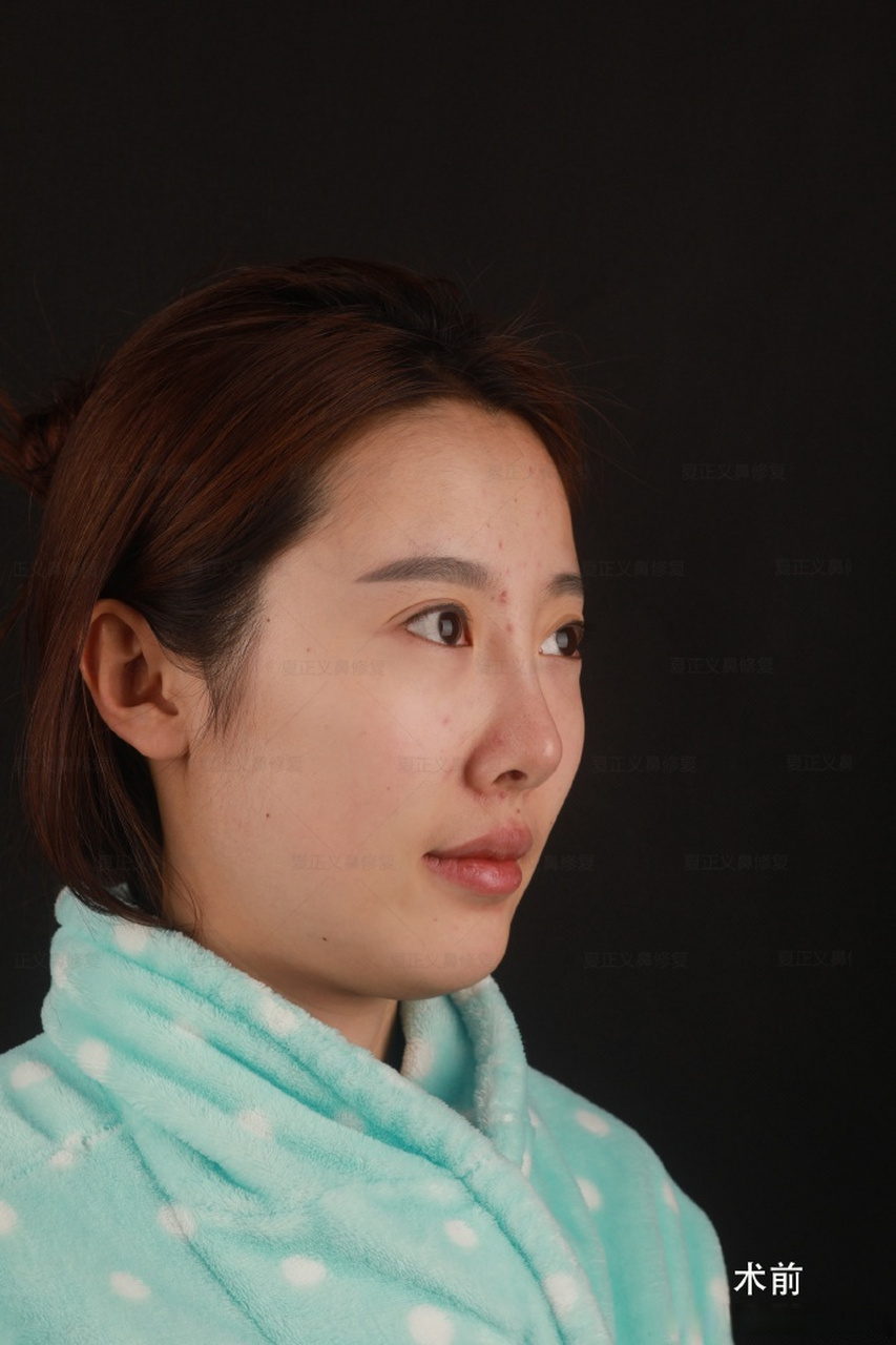 很多人做鼻子,山根并没有做的很高,却依然做成了通天鼻,这是为什么呢?