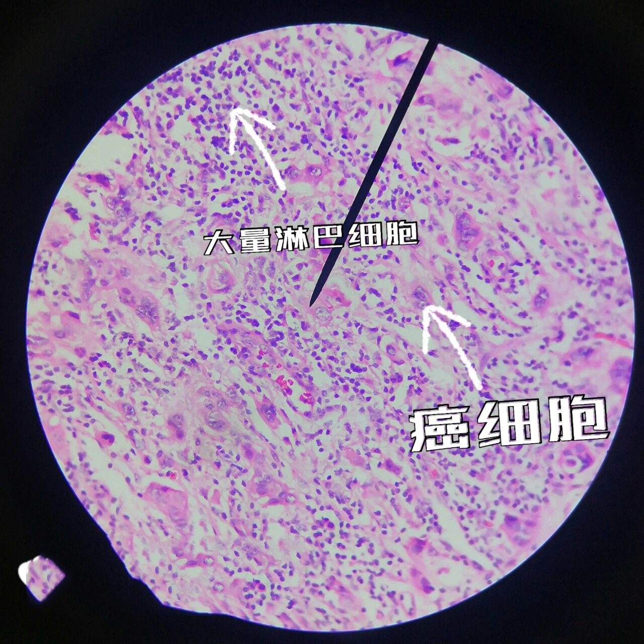 恶性肿瘤切片图片