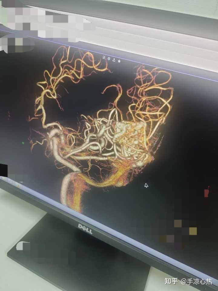 先天脑血管畸形的年轻人就没有未来了吗