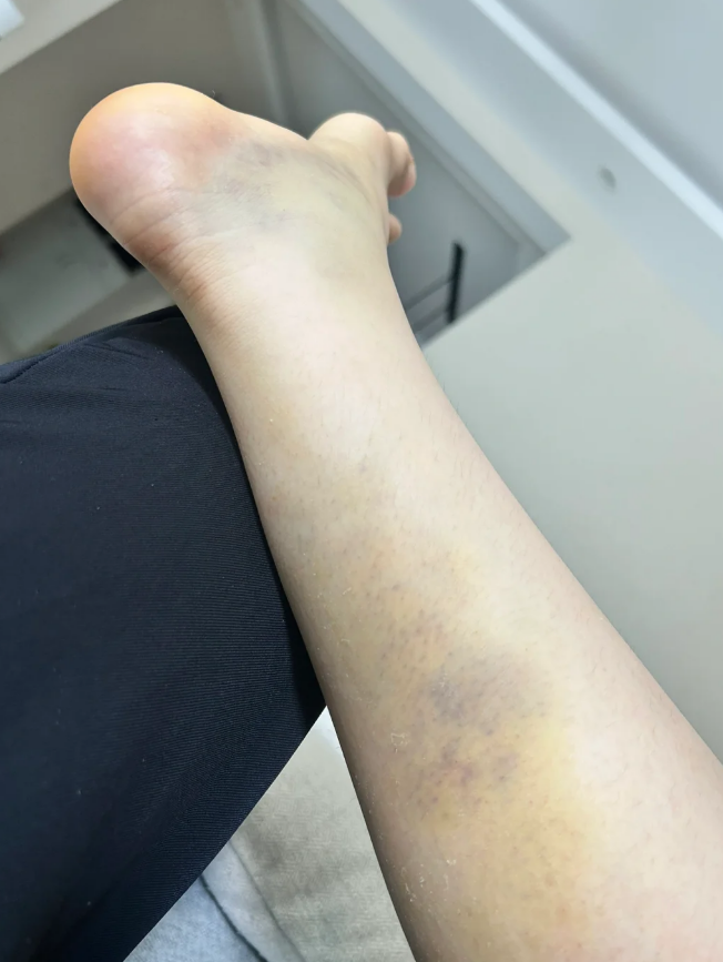 小腿拉伤后,如果情况不严重,通常可以自行恢复,一般需要4到6周时间