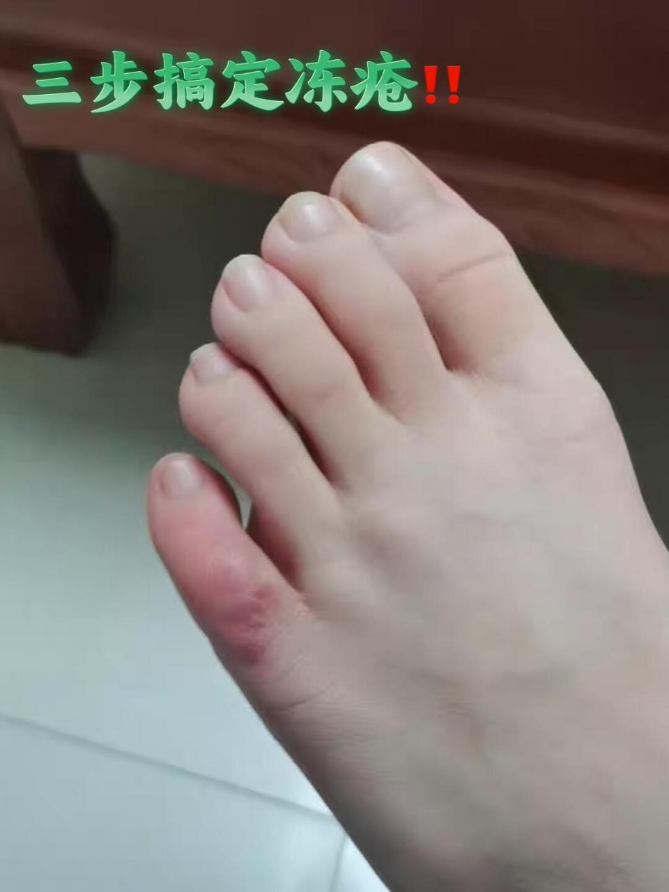 给她说今年脚冻疮了 简直就像甲沟炎一样 太难受了 走路是真的很不
