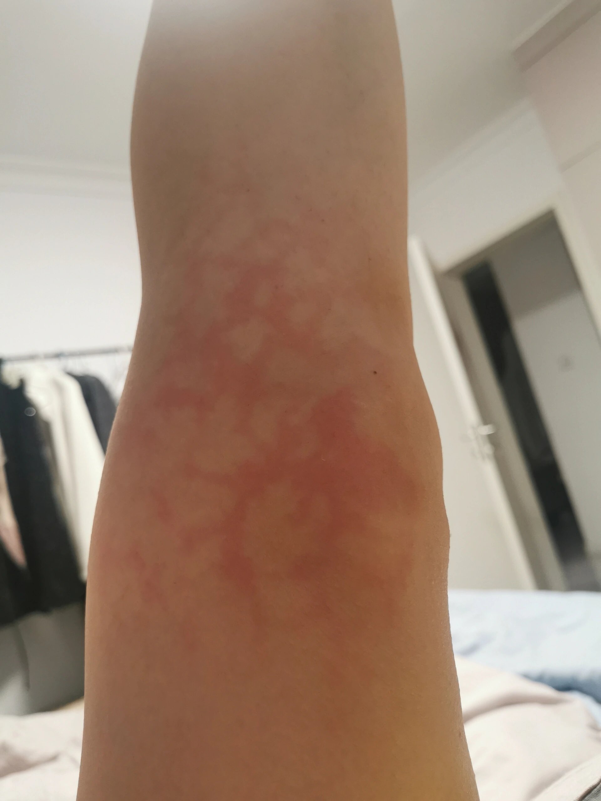 皮肤出现蜘蛛纹 为啥用理疗灯烤一烤皮肤就会出现这种网状红纹?