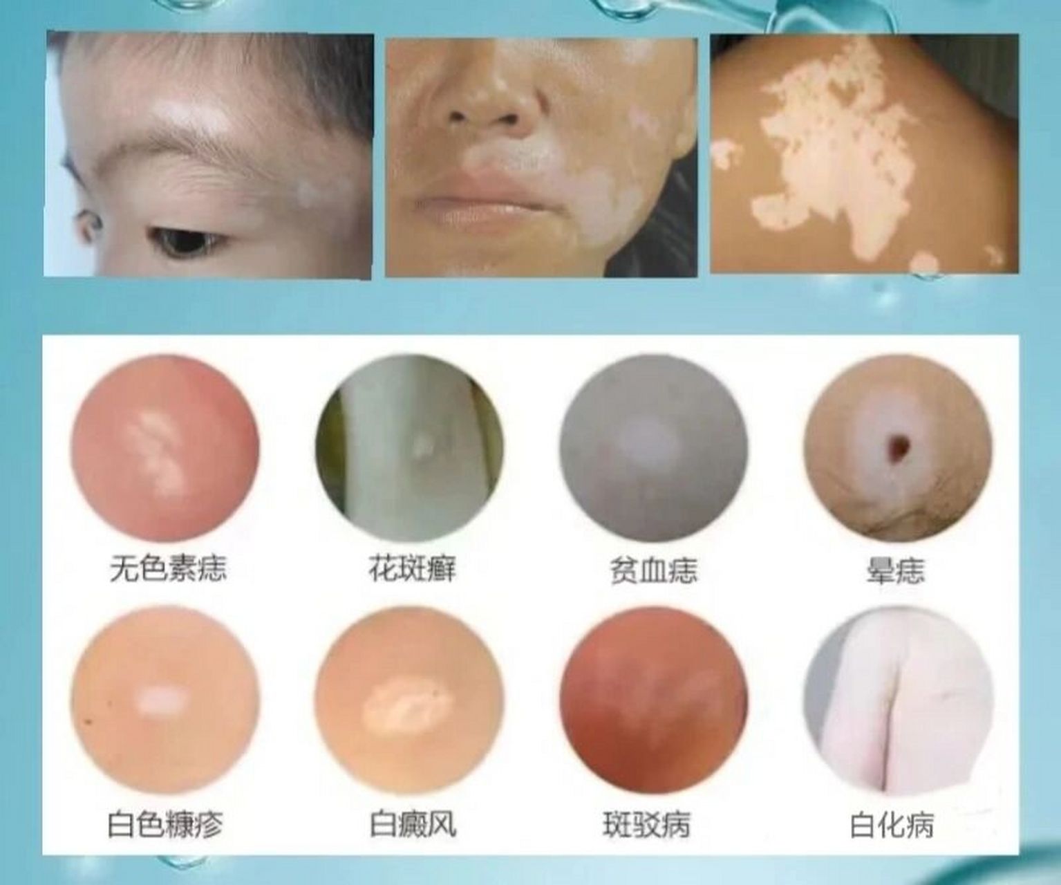 无色素痣:先天性的白斑疾病.