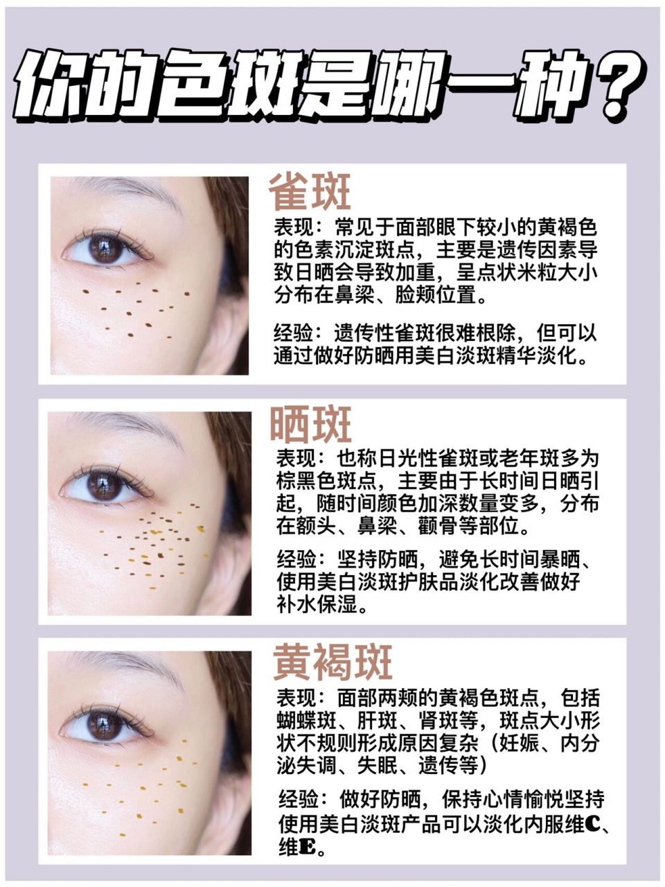 斑点类型科普|没分清就别再瞎淡斑了 7515雀斑表现:常见于面部眼
