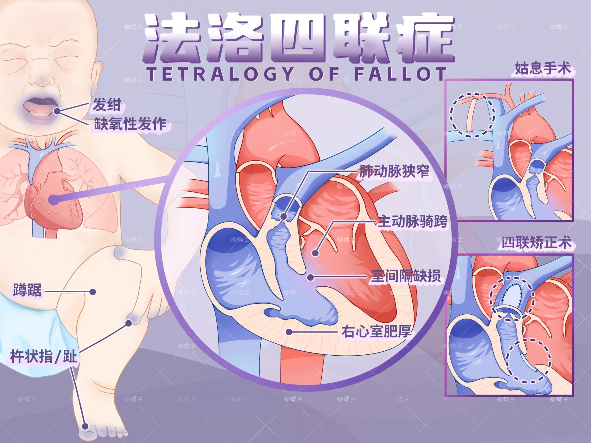 医学插画| 法洛四联症