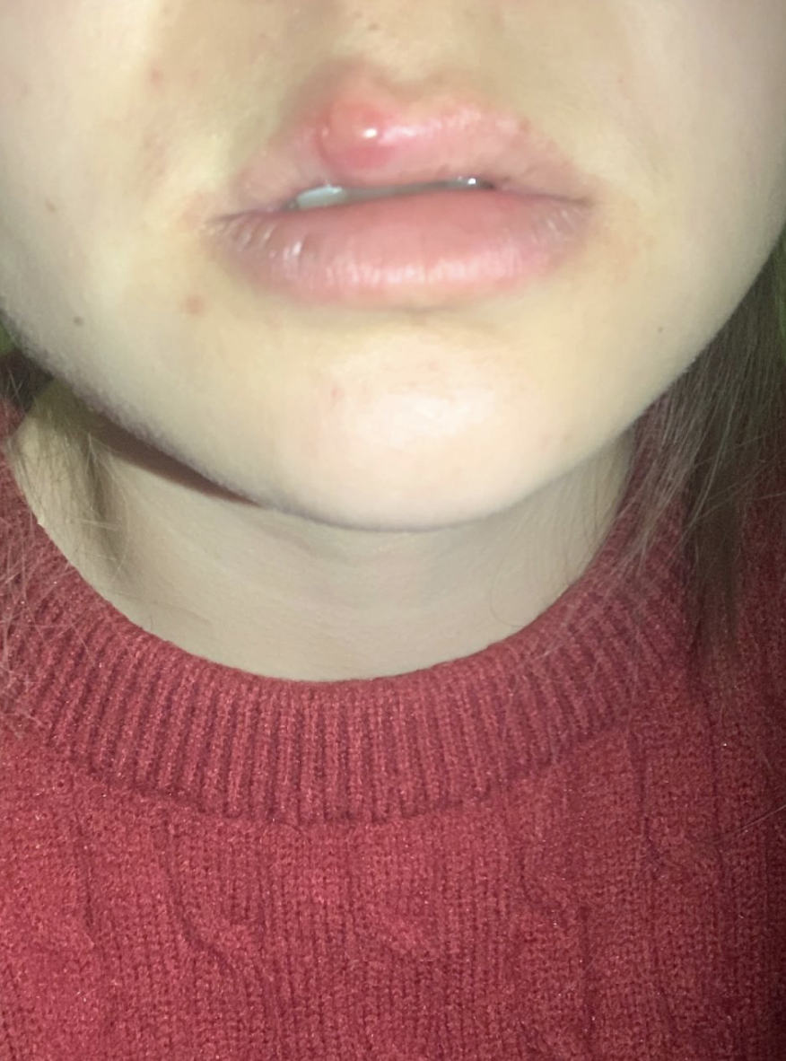 这种病是由1型单纯疱疹病毒引起的