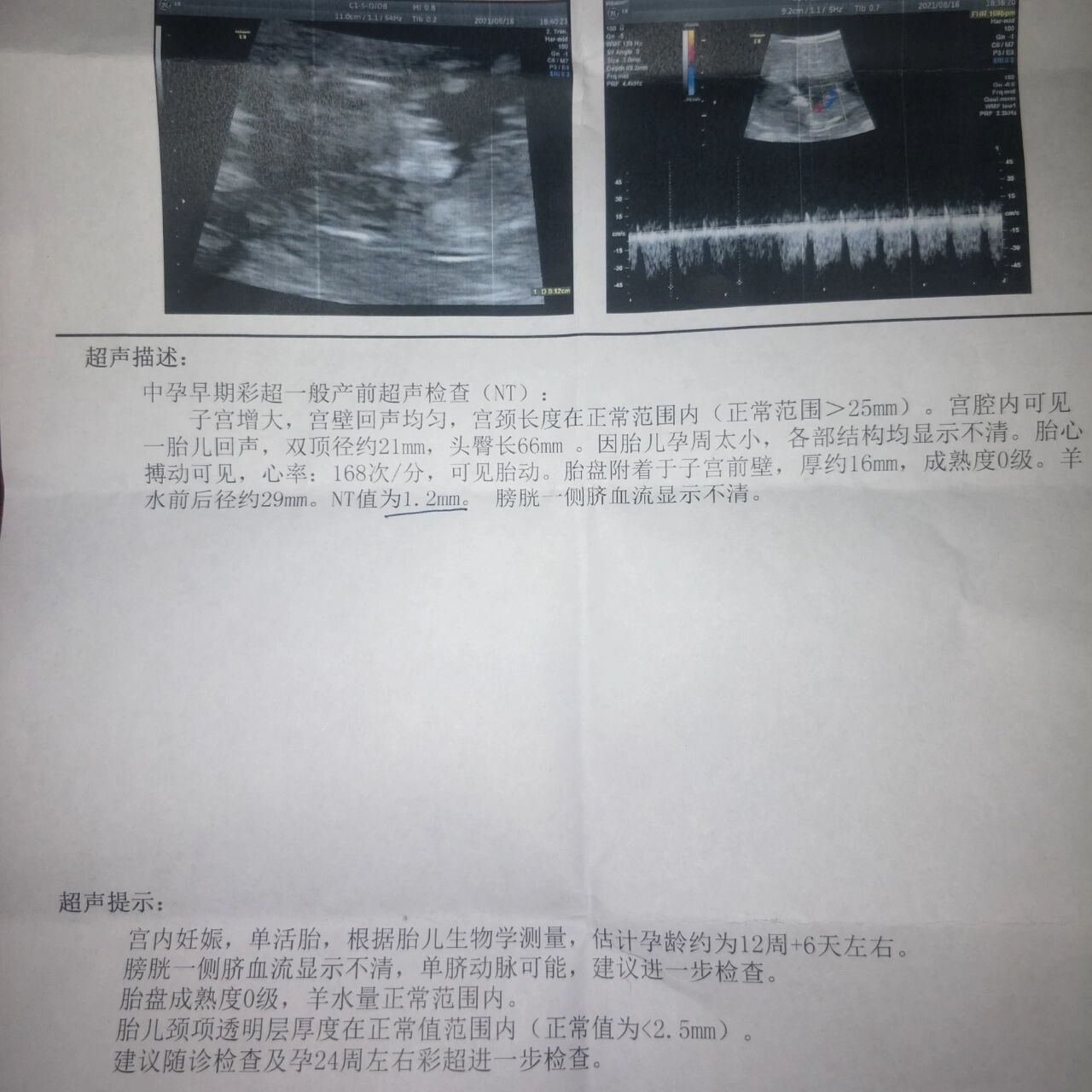 因胎儿孕周太小,宝宝各部结构显示不清 主治医生说 nt 值正常不用