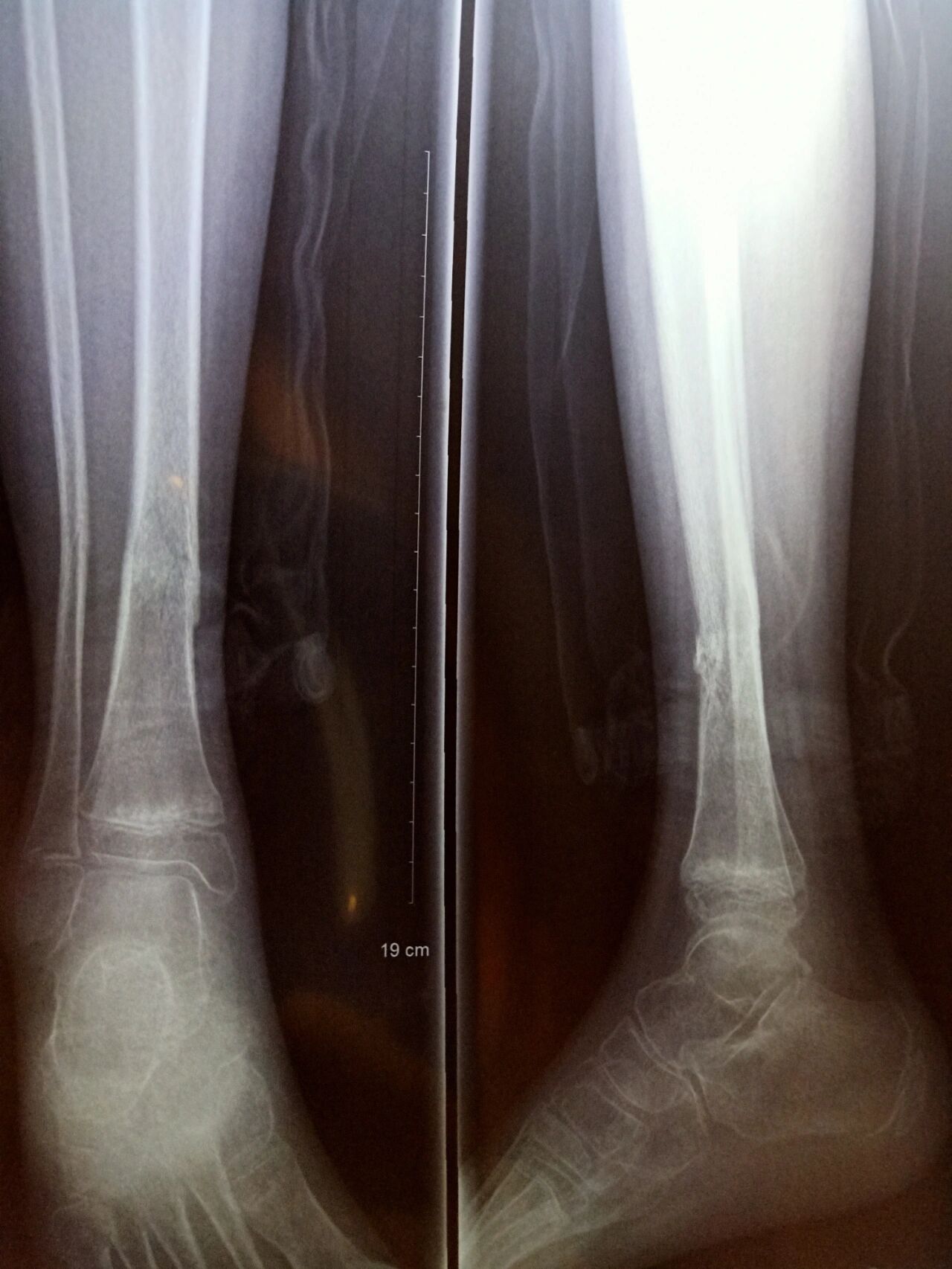 胫腓骨下段骨折13周了,去医院拍片骨头基本已经愈合