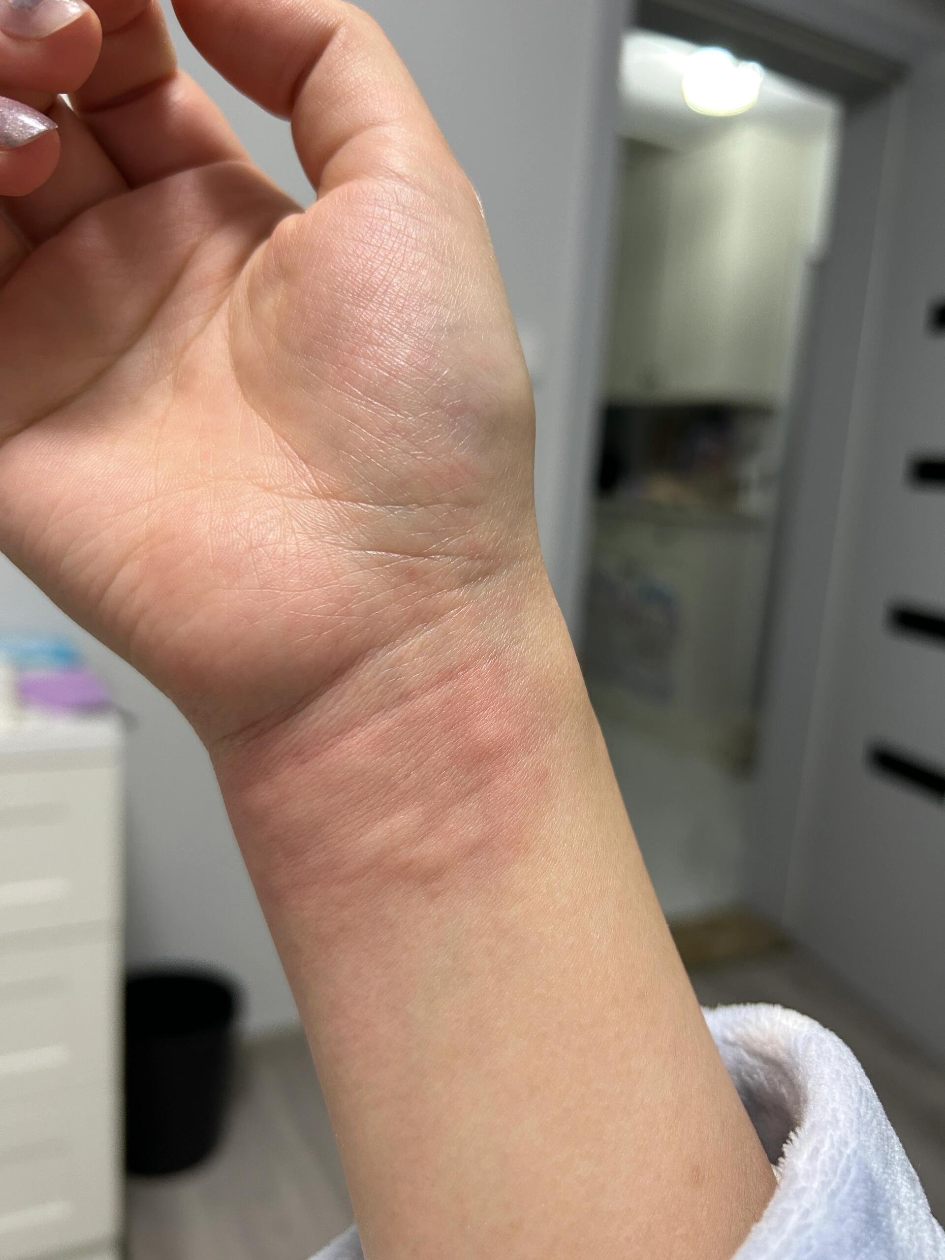 救命,咱就是说吃螃蟹过敏真可怕