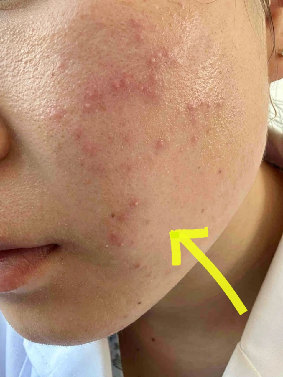 先来介绍一下本过敏脸皮肤状况: 长了好多小红疙瘩,不仅看上去很突兀