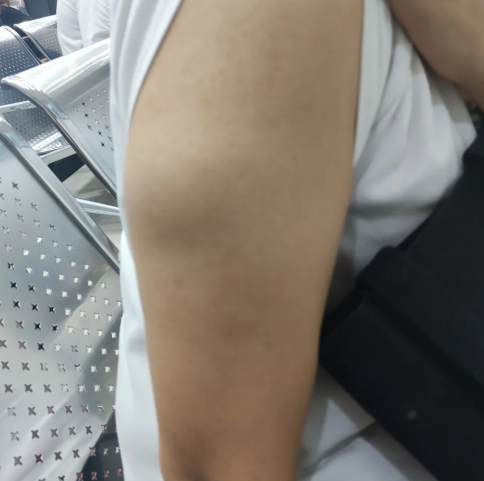 胳膊上起个筋包一碰就疼是怎么回事怎么办?