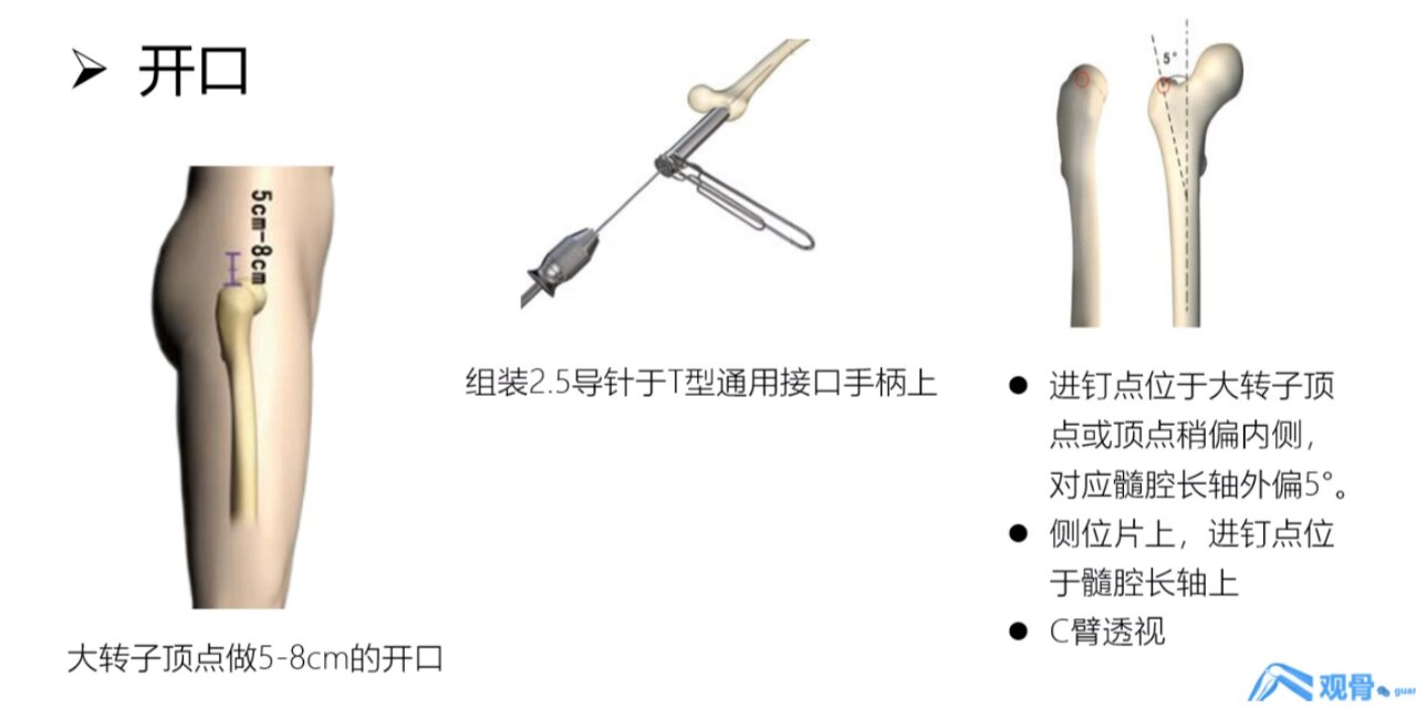 股骨髓内钉(pfna)手术步骤