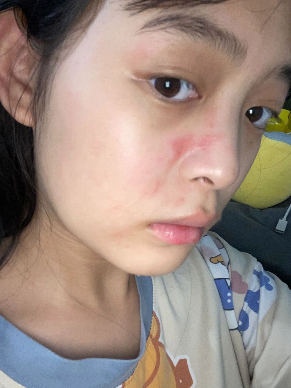 被隐翅虫咬了,真的会谢 现在看到这玩意儿,真的毛骨悚然
