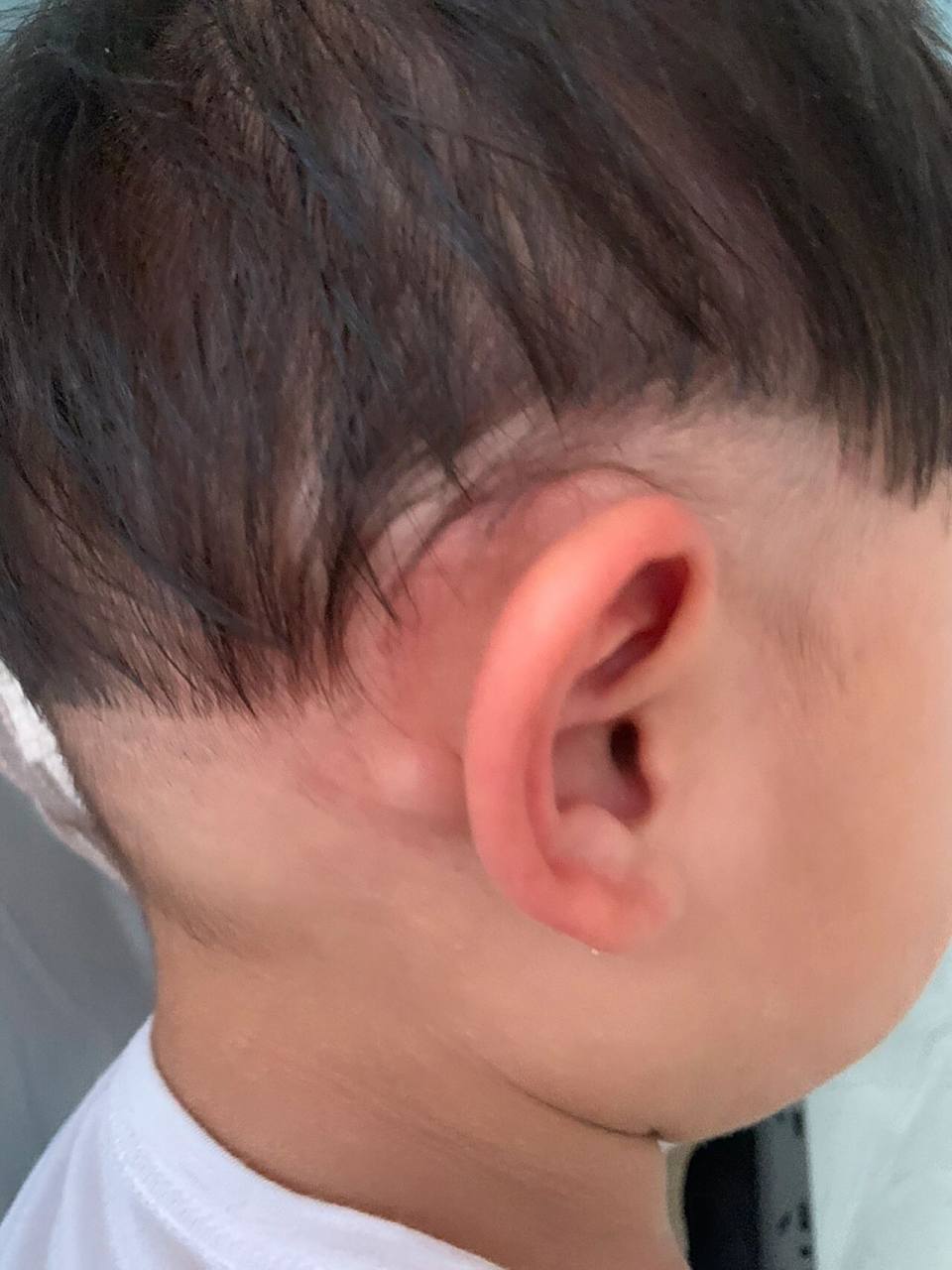 宝宝耳后有一个小疙瘩,慌的老母亲一批