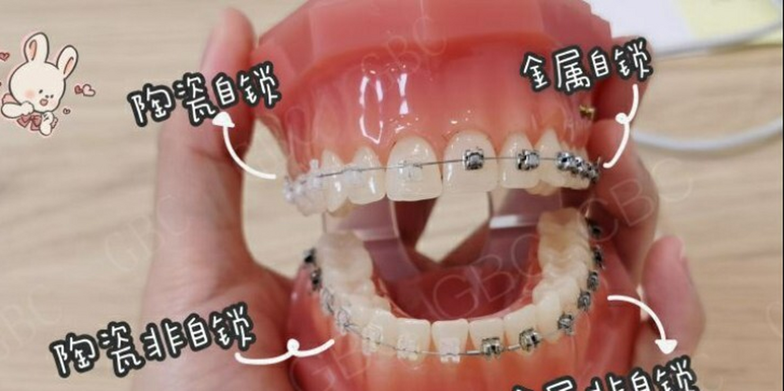 什么是金属自锁托槽?