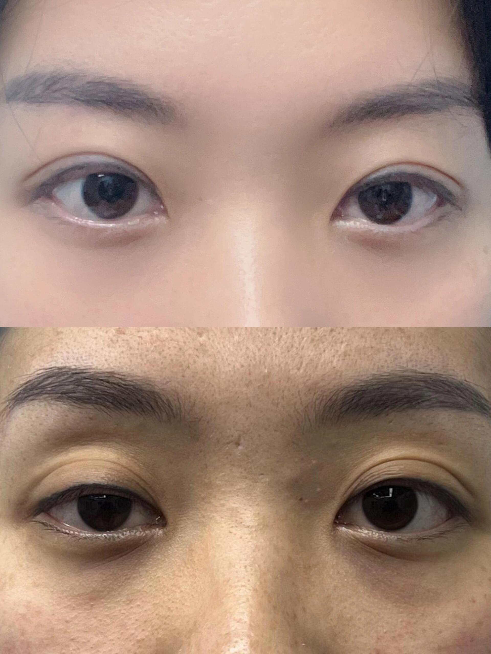 我自卑了三年…… 三年前查出甲状腺癌,去97给的方案是两侧全切,我